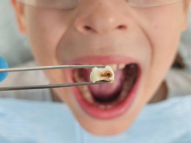Best Emergency Broken Tooth Repair in Pequot Lakes, MN